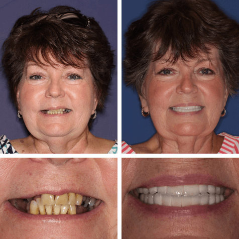 Dental Implant from PGA Dentistry