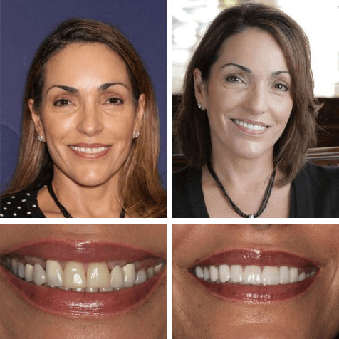 Smile transformation at PGA Dentistry