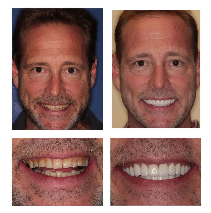A collage of before and after photos of a patient, Patricia of PGA Dentistry.