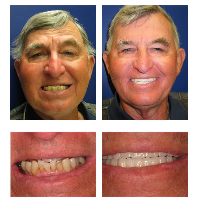 A collage of before and after photos of a male patient of PGA Dentistry.