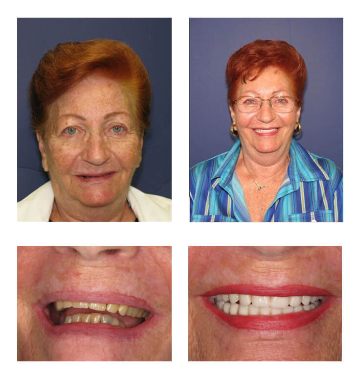 A collage of before and after photos of a patient, Ina of PGA Dentistry.
