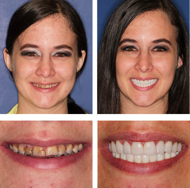 A collage of before and after photos of a patient, Jackie of PGA Dentistry.