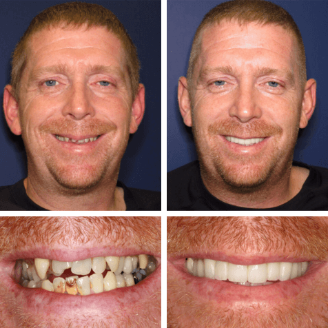Smile transformation at PGA Dentistry
