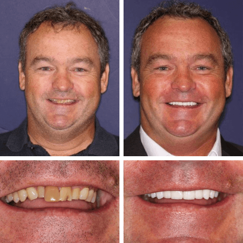 Smile transformation at PGA Dentistry