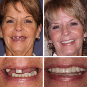 Teeth Next Day® from PGA Dentistry