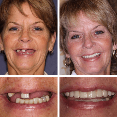 Teeth Next Day® from PGA Dentistry