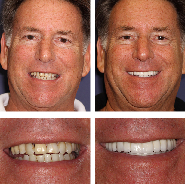A collage of before and after photos of a patient, Lenny of PGA Dentistry.