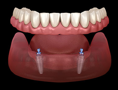 Snap-On Teeth®