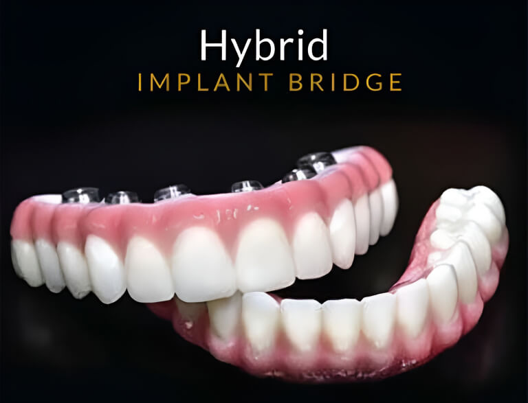 Hybrid Bridge