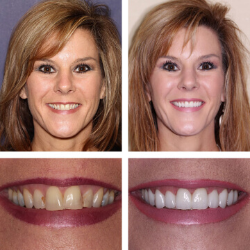 Cosmetic Dentistry Smile transformation at PGA Dentistry
