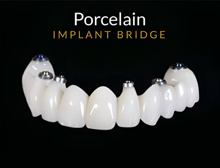 Porcelain Bridge