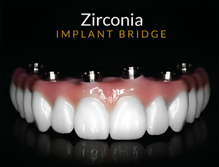 Zirconia Bridge