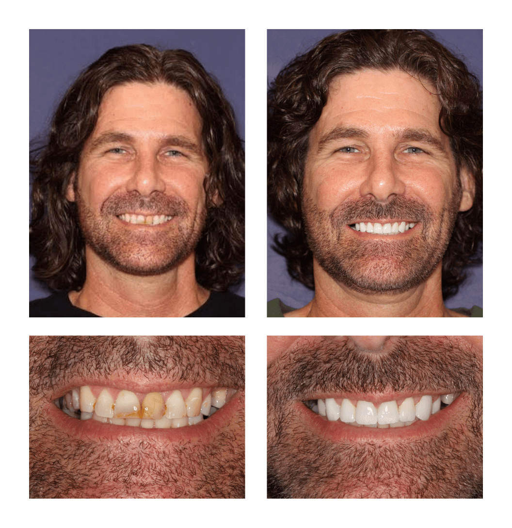 Cosmetic Dentistry before and after at PGA Dentistry