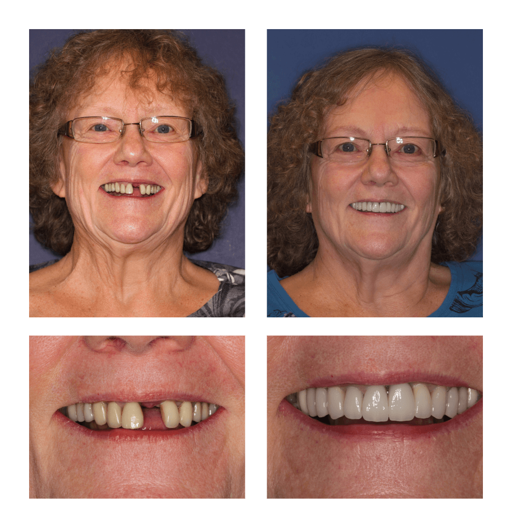 Single Tooth Replacement at PGA Dentistry