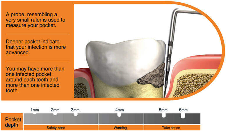periodontal disease