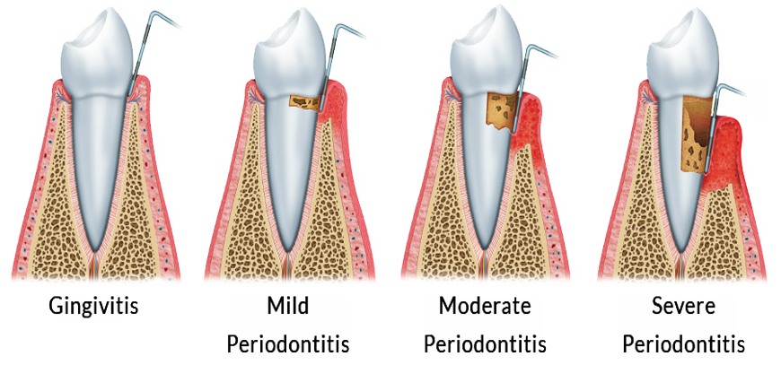 mild periodontitis