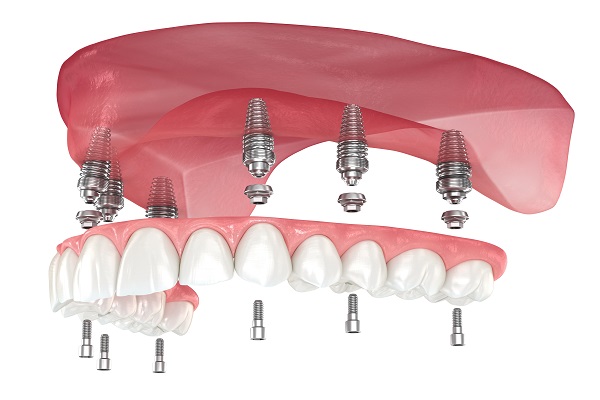 all-on-6 dental implants in Palm Beach Gardens