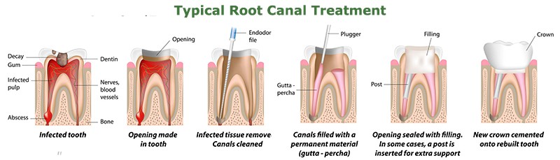 root canals in Palm Beach Gardens
