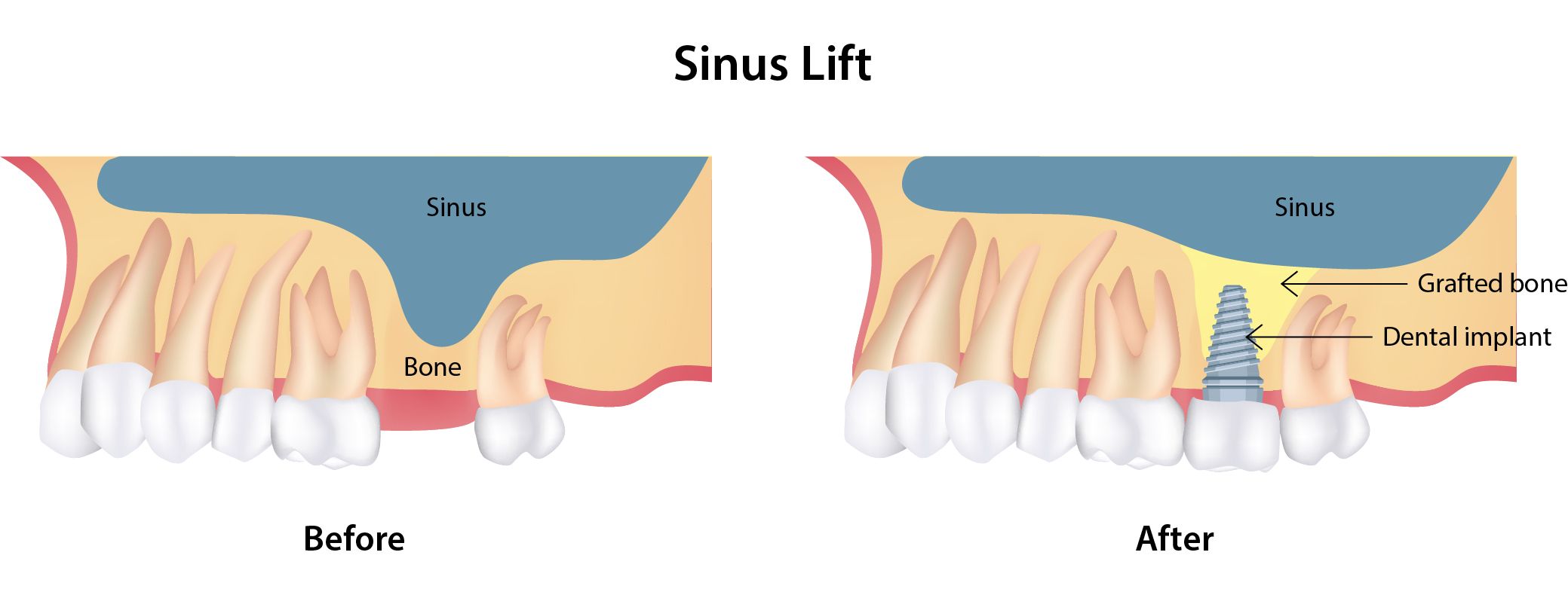 Sinus lift from PGA Dentistry