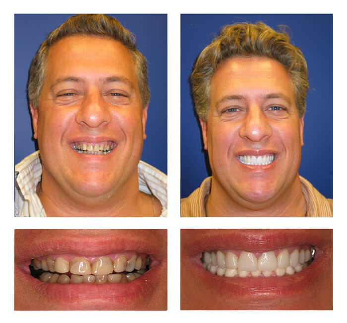 before and after treatment at PGA Dentistry - best dentist near you