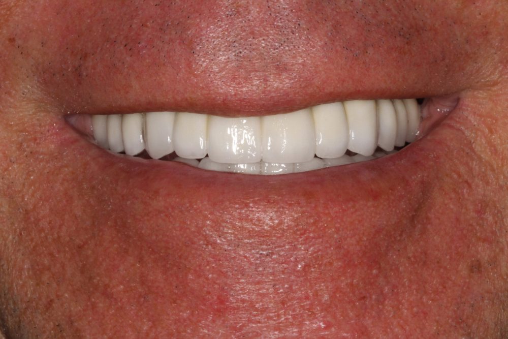 Lenny's smile after treatment