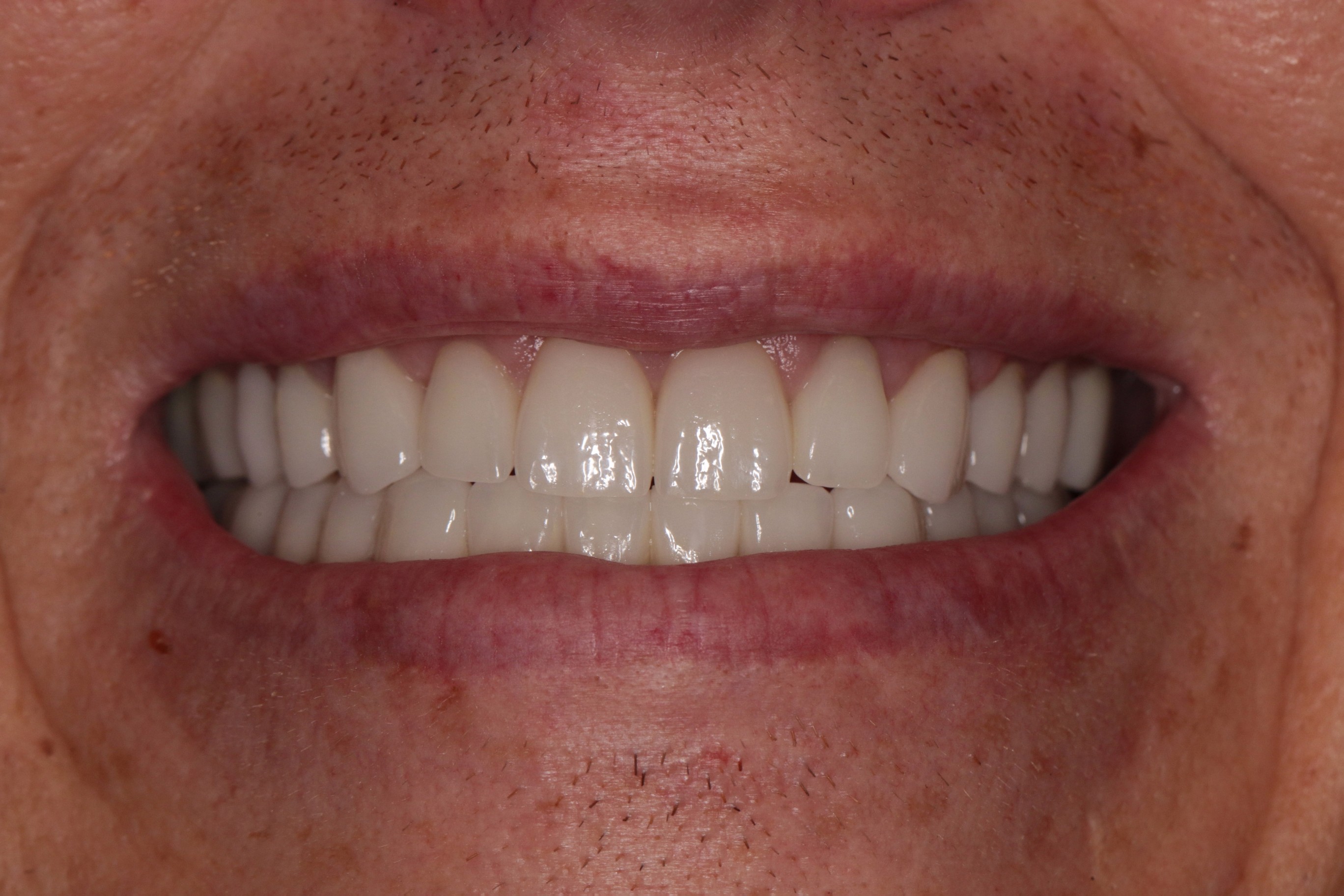 after treatment smile at PGA Dentistry