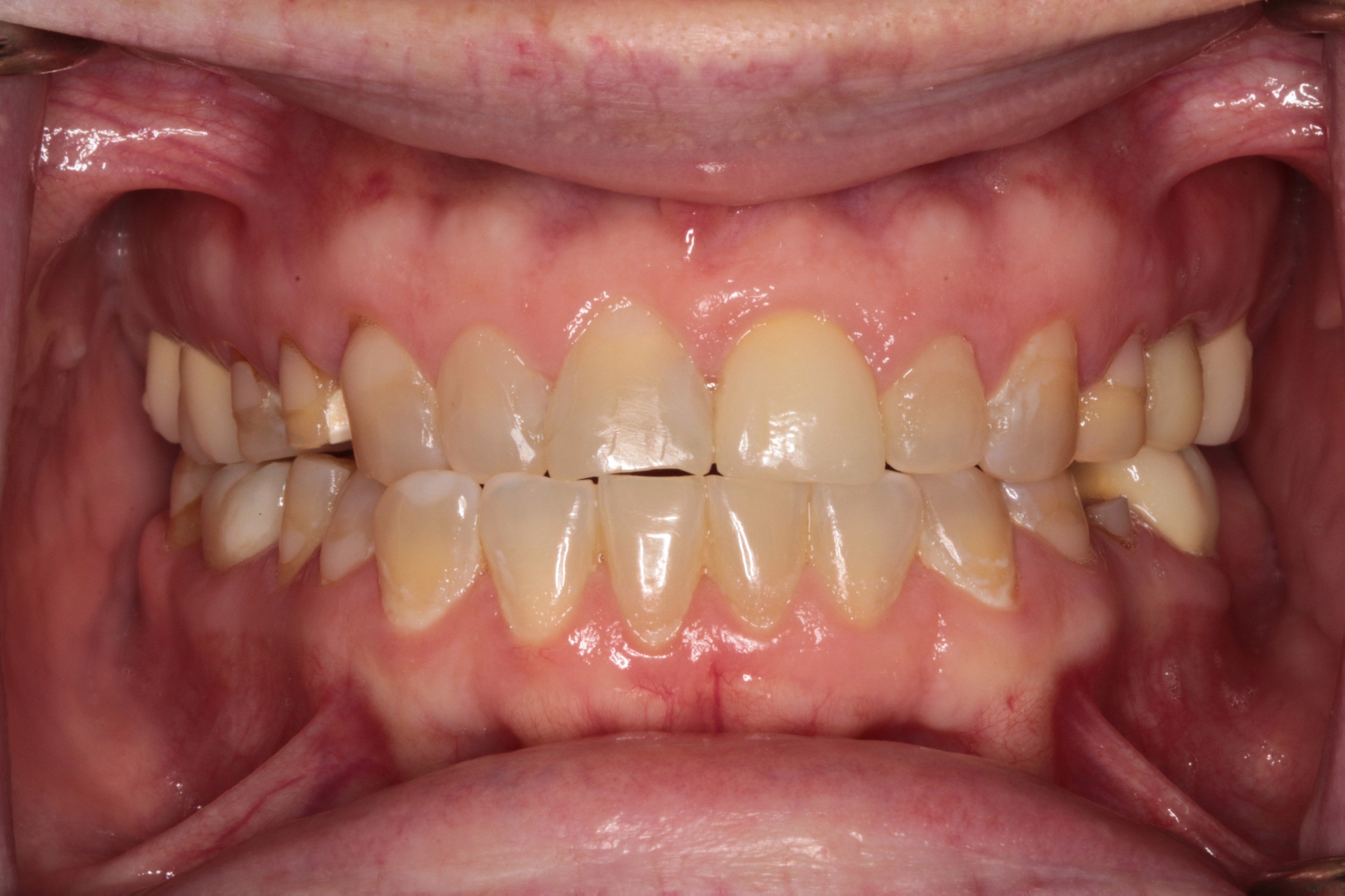 Before-Retracted-2