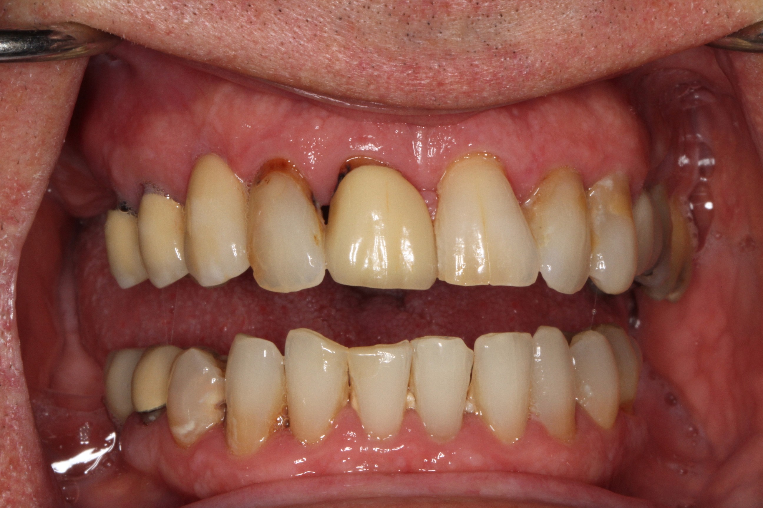 Before-Retracted-3