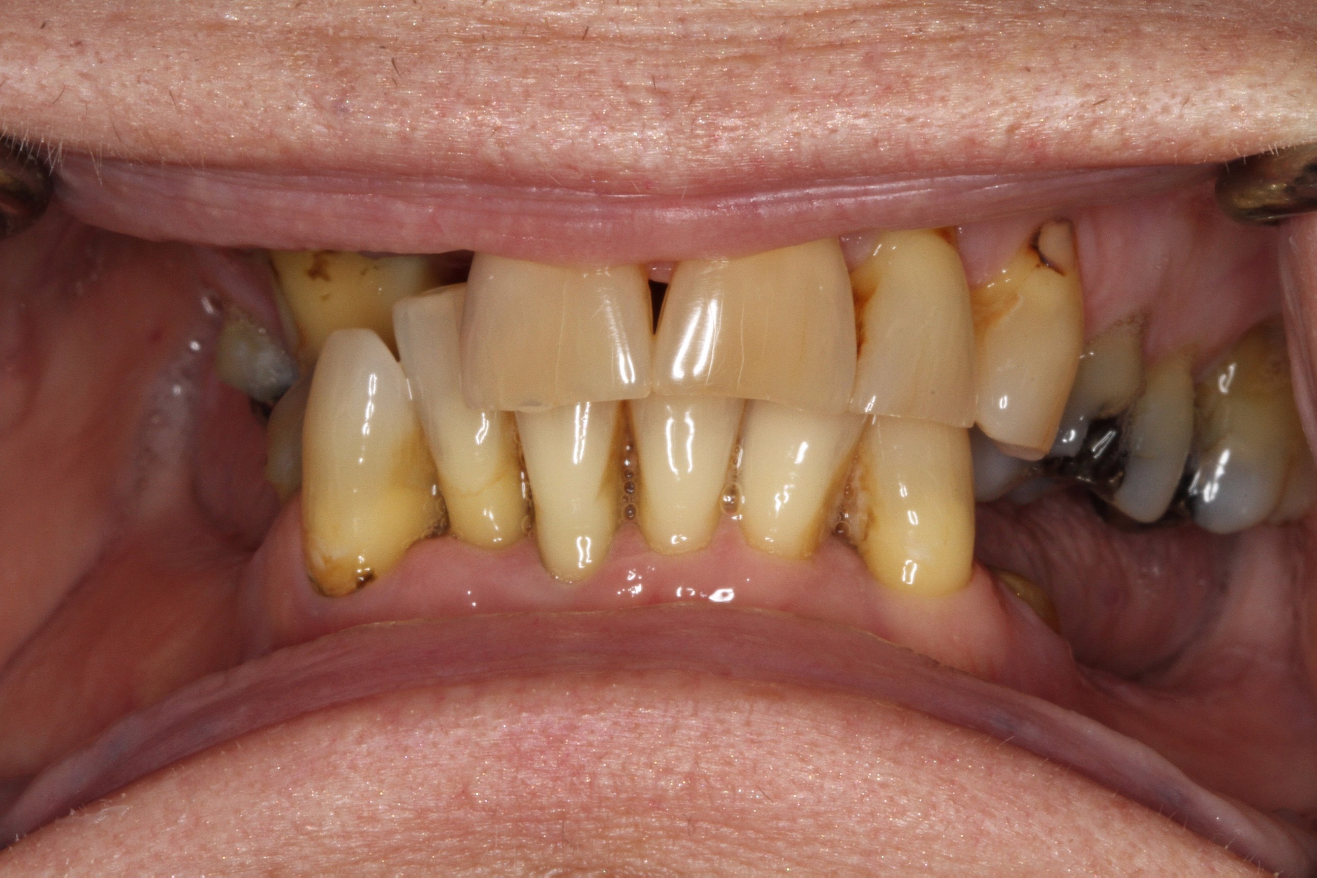 before treatment smile at PGA Dentistry