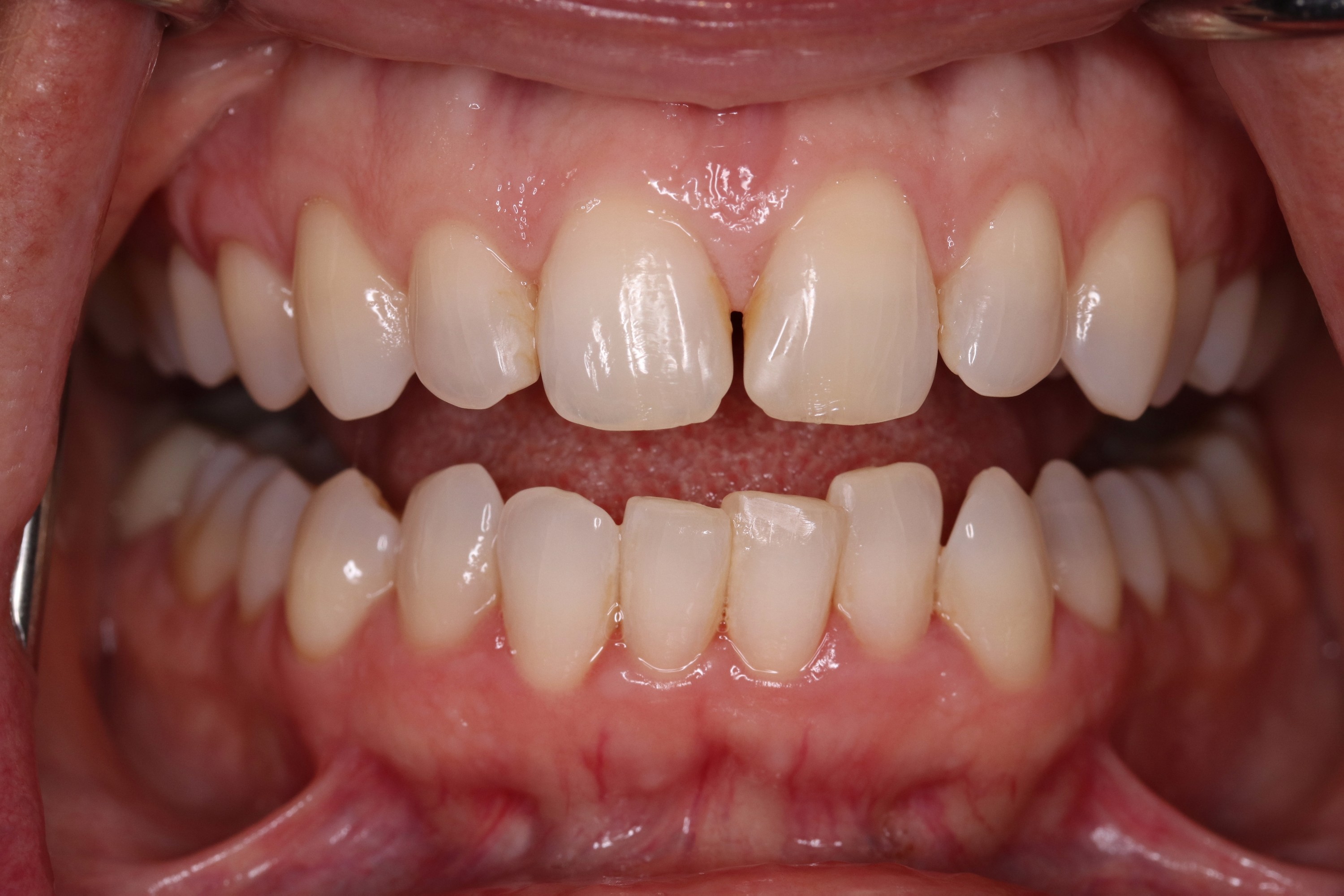 before treatment smile at PGA Dentistry