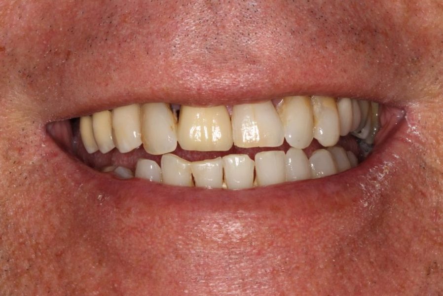 Lenny's smile before treatment