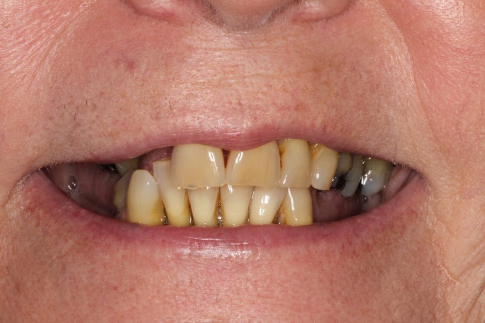 Linda's smile before treatment