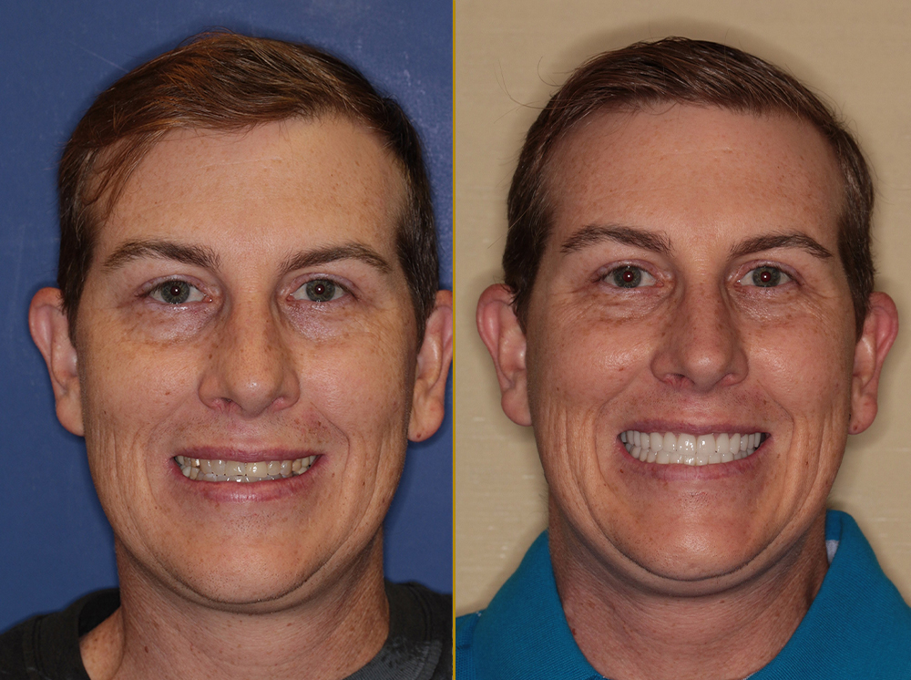 before & after treatment smile at PGA Dentistry