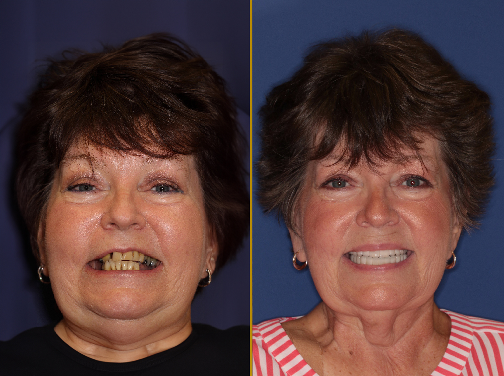 Linda before treatment