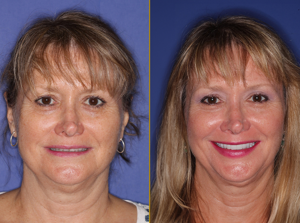 before and after dental treatment at PGA Dentistry