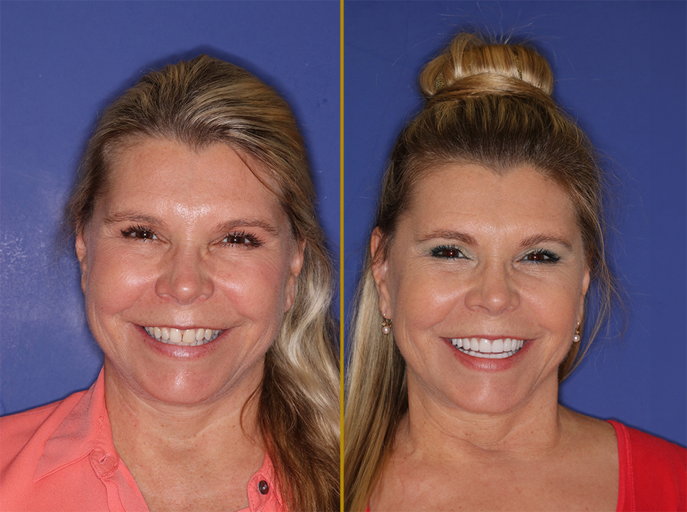 before and after dental treatment at PGA Dentistry