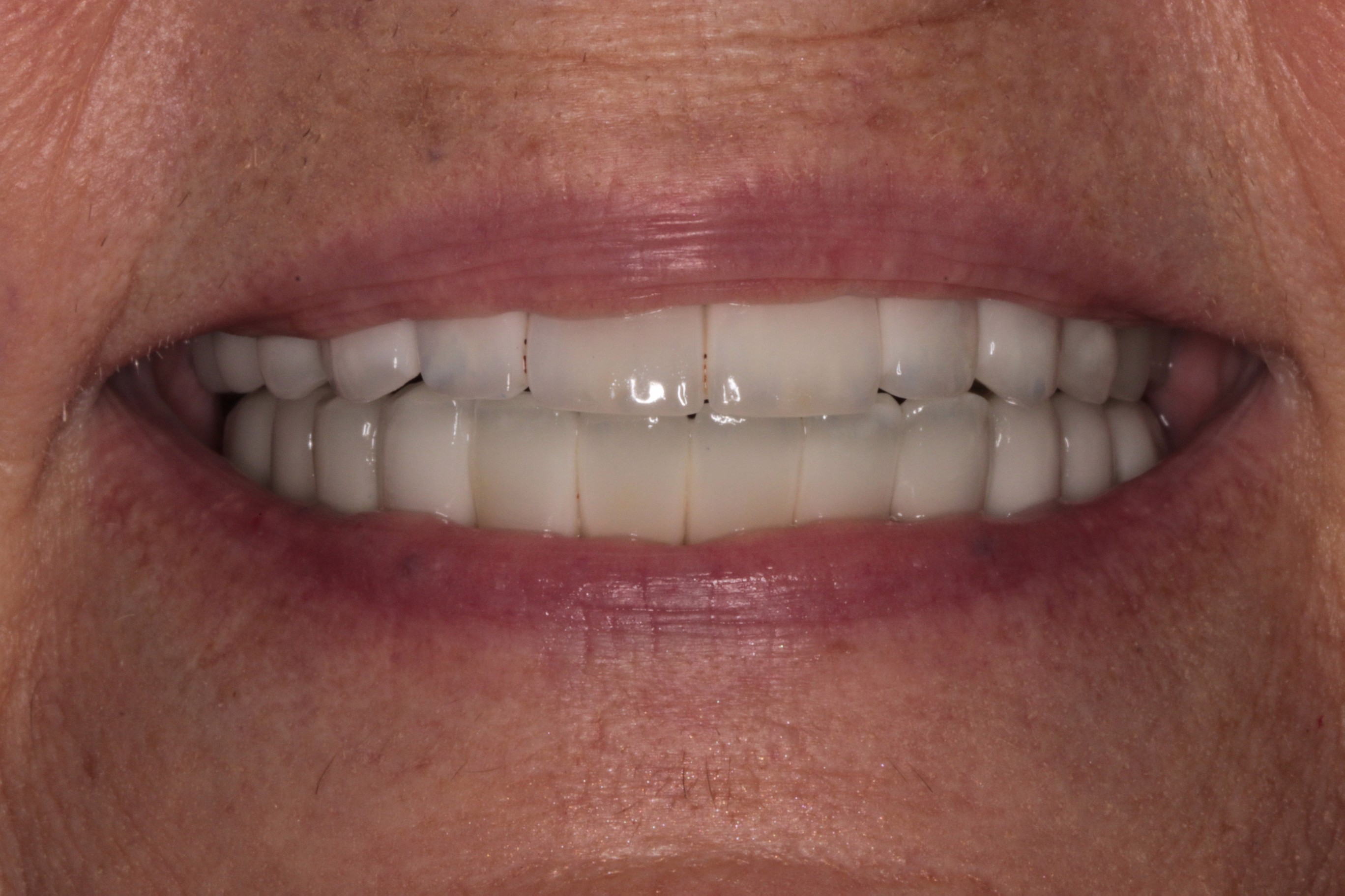 new patient smile from PGA Dentistry