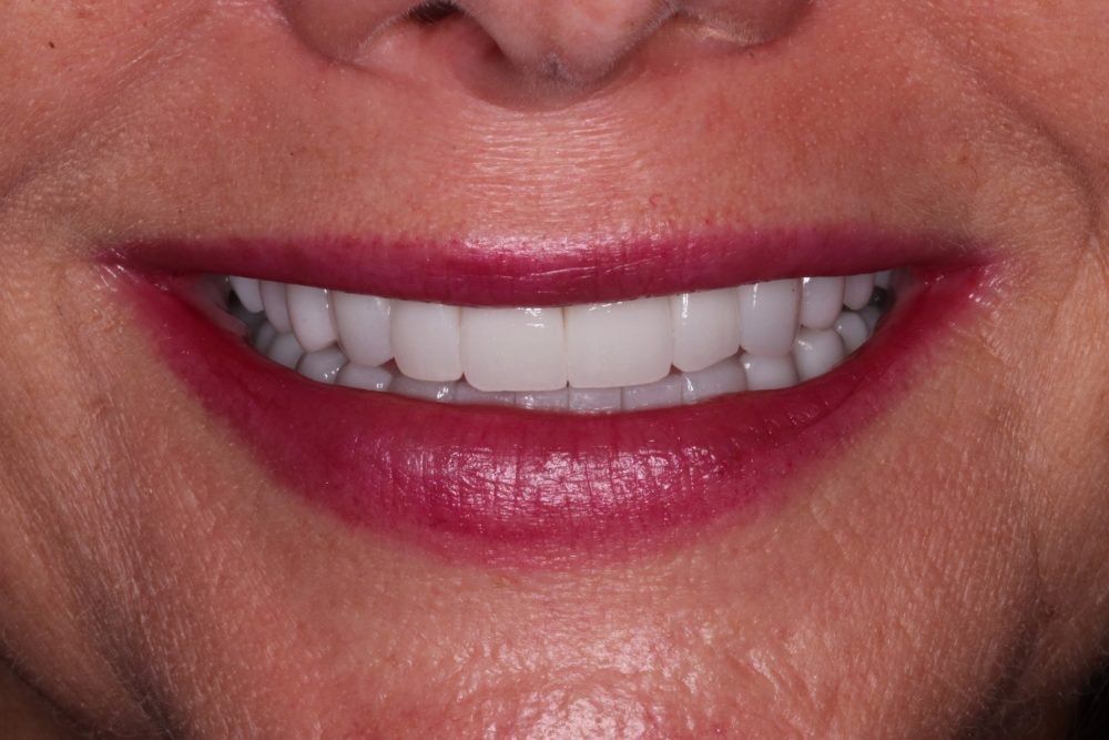 after treatment smile at PGA Dentistry
