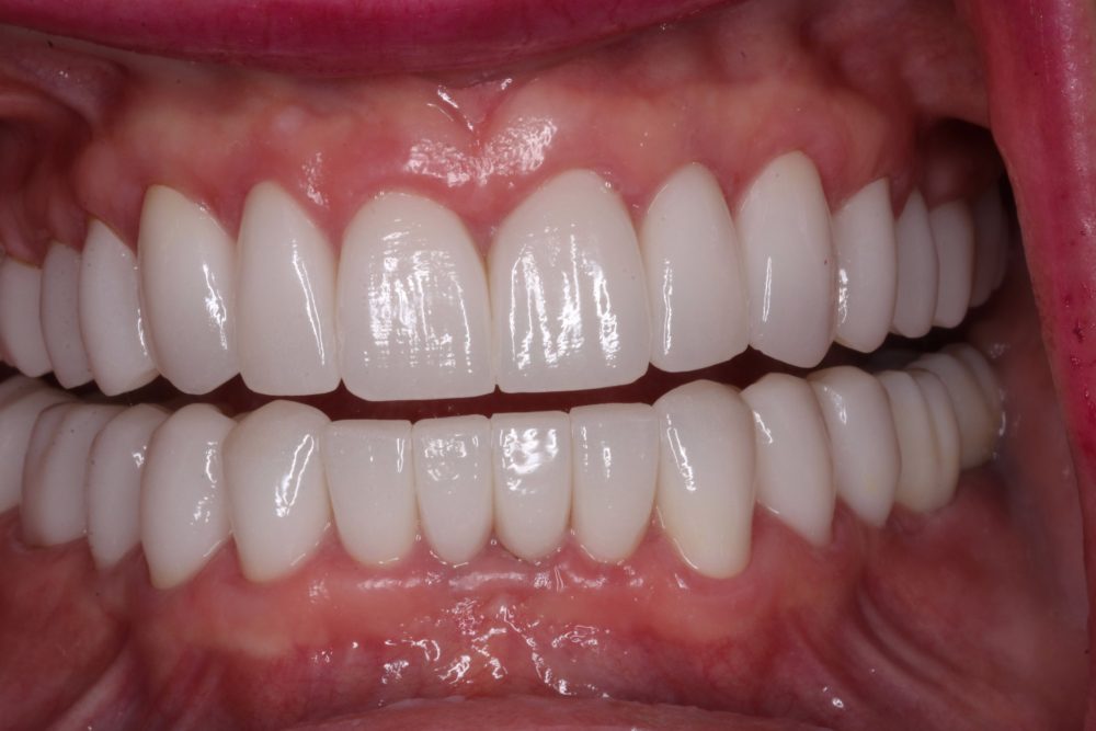 Janice's smile after treatment